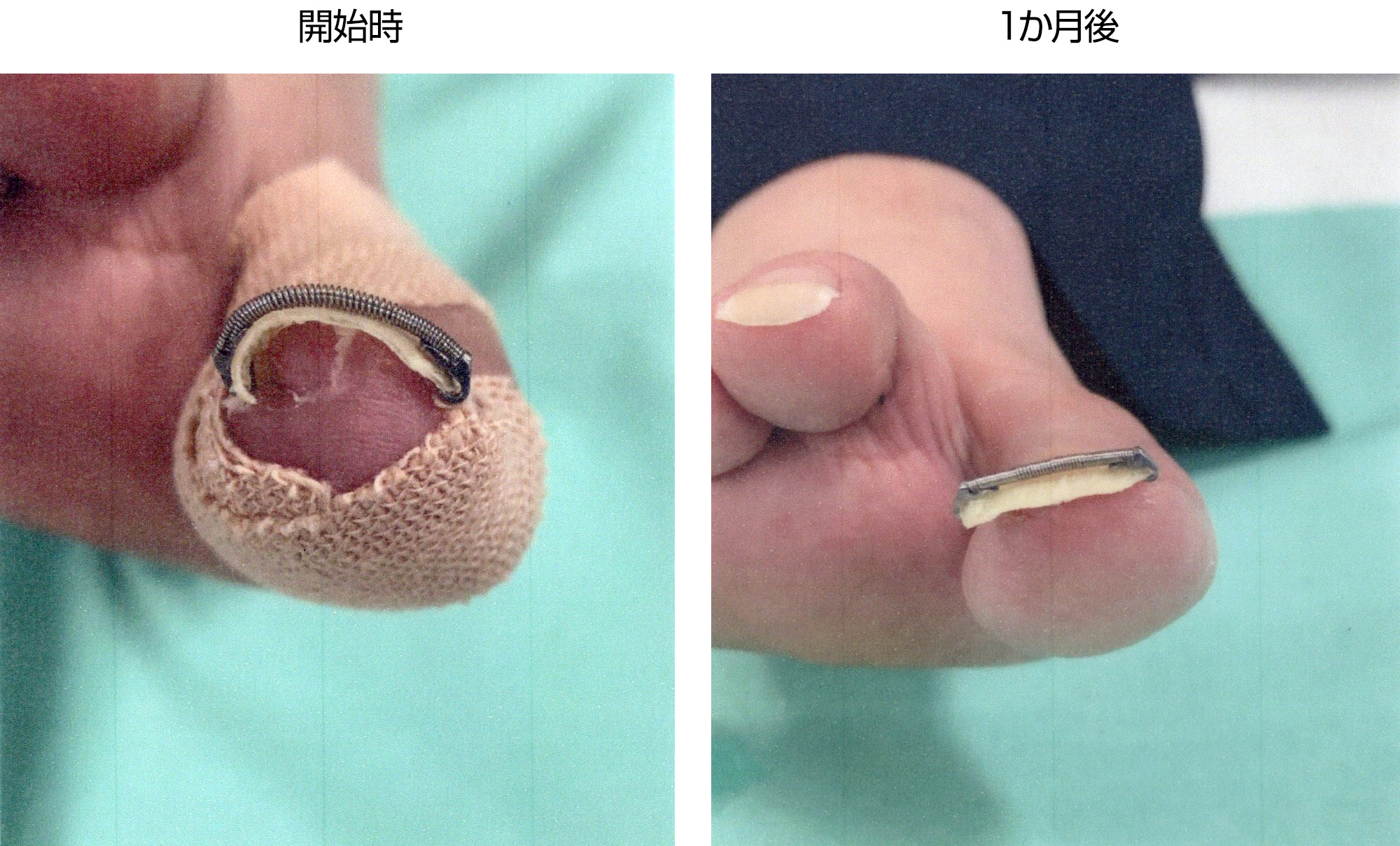 巻き爪治療開始時～１か月後