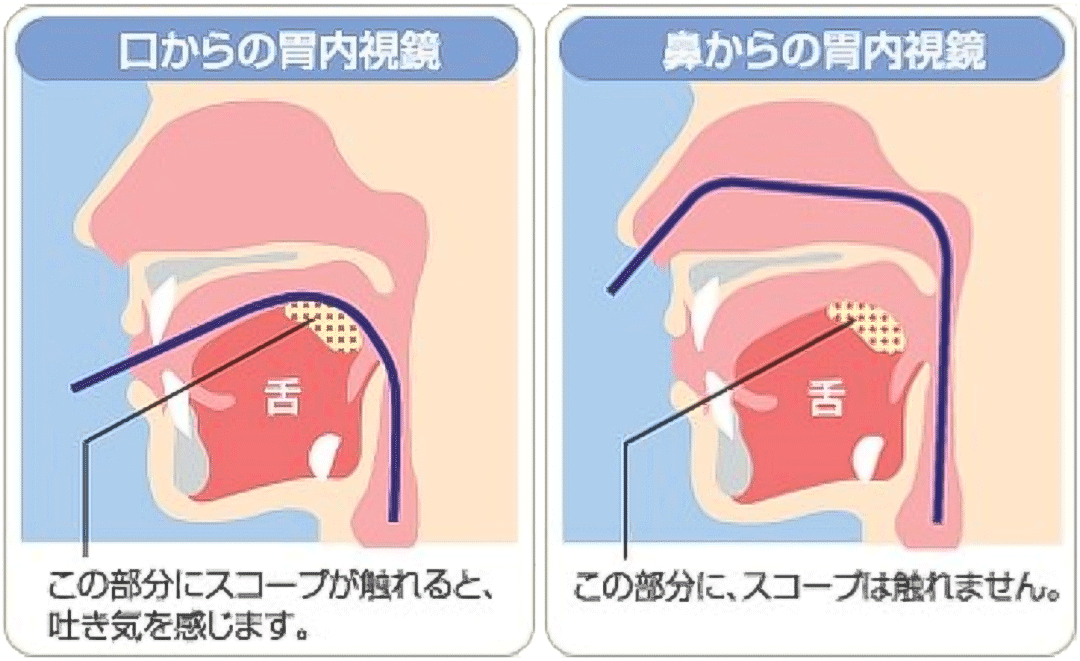 経鼻内視鏡の図